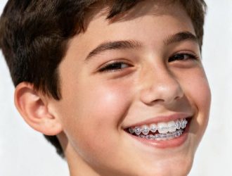 Как работают элайнеры для детей и подростков