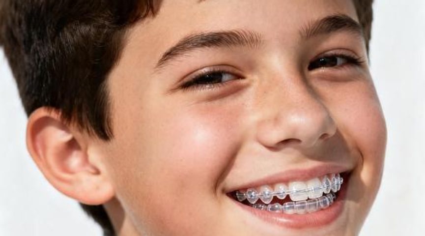 Как работают элайнеры для детей и подростков